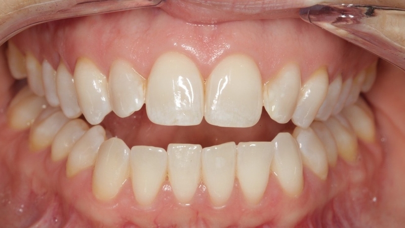Khớp cắn hở là gì? Nguyên nhân và cách điều trị khớp cắn hở 1