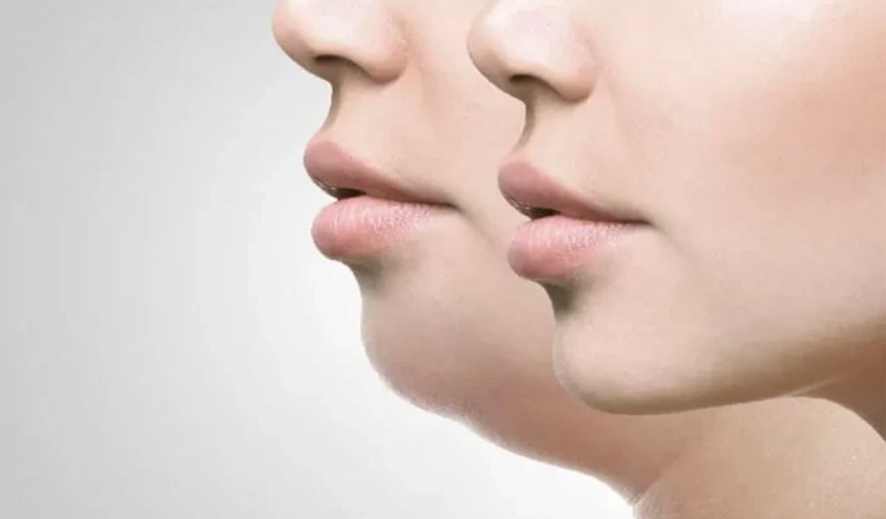 Khớp cắn ngược có nên tập Mewing không? 1