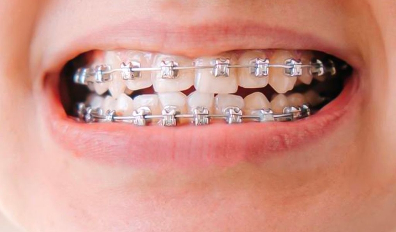 Khớp cắn ngược có nên tập Mewing không? 2