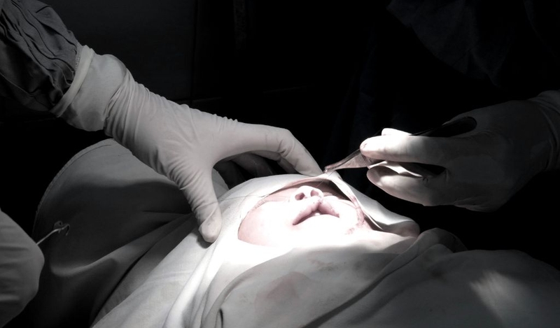 Khớp cắn ngược có nên tập Mewing không? 3