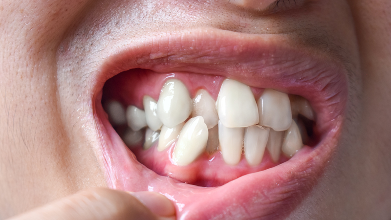 Khớp cắn ngược là gì? Nguyên nhân, dấu hiệu và cách chữa trị hiệu quả 1