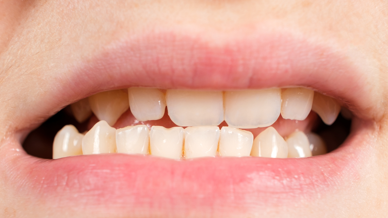 Khớp cắn ngược là gì? Nguyên nhân, dấu hiệu và cách chữa trị hiệu quả 2