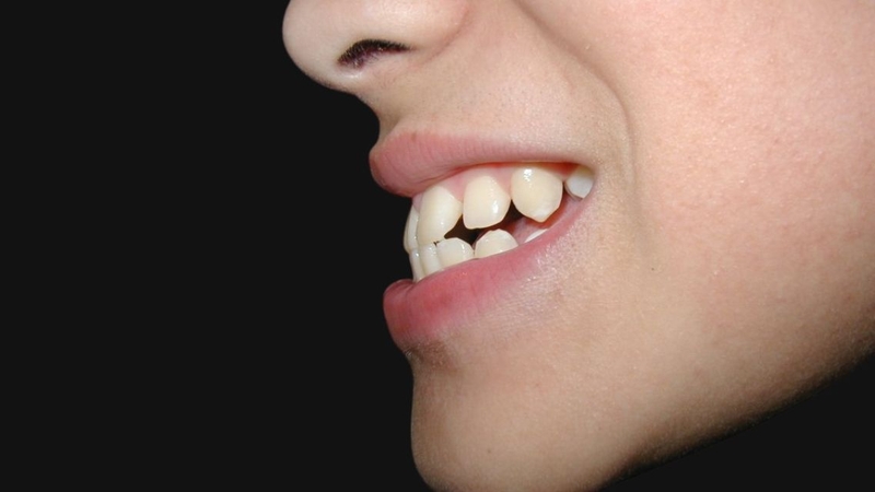 Thế nào là khớp cắn ngược nhẹ? Nguyên nhân, nhận biết và cách điều trị 2