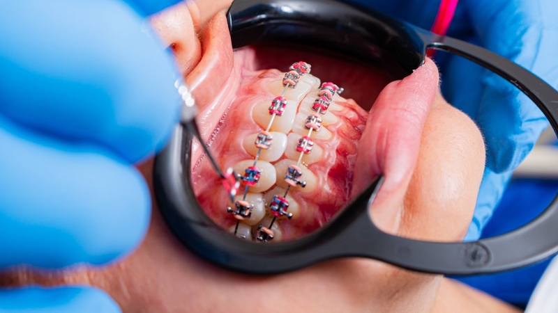 Thế nào là khớp cắn ngược nhẹ? Nguyên nhân, nhận biết và cách điều trị 3