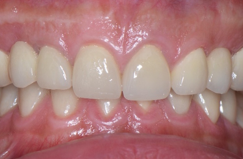 Khớp cắn sâu là gì? Nguyên nhân gây khớp cắn sâu 1