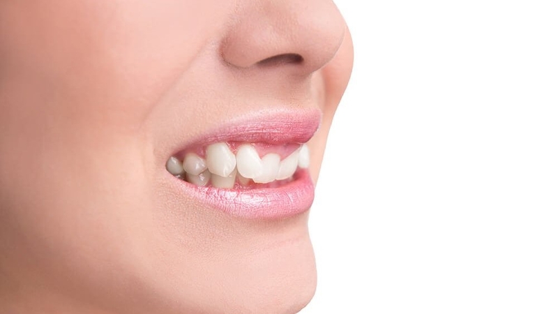 Khớp cắn sâu là gì? Nguyên nhân gây khớp cắn sâu 2