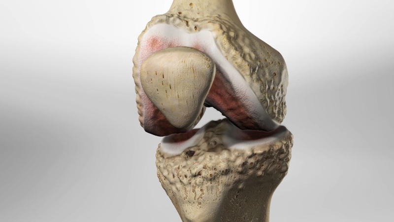 Khớp gối nhân tạo và những thông tin quan trọng bạn nên biết 2