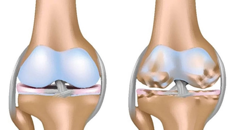 Khớp xương kêu răng rắc cảnh báo bệnh lý gì?2