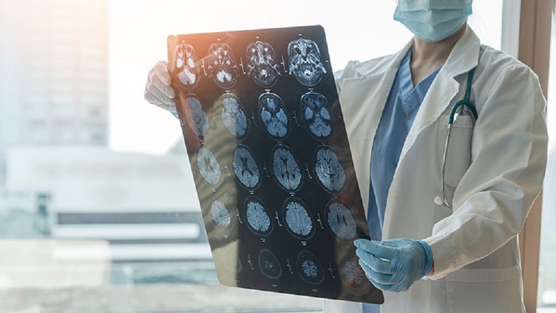 Kích thích thần kinh phế vị là gì? Quy trình thực hiện từng bước ra sao? 3