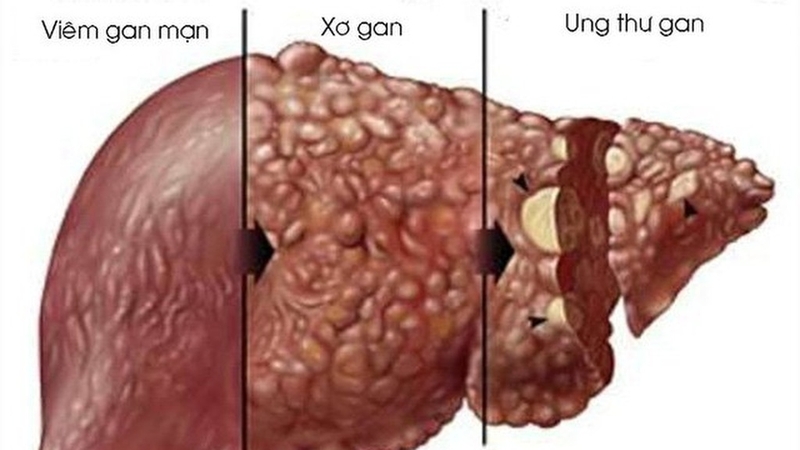 Kích thước gan bình thường: Hiểu biết quan trọng cho sức khỏe của bạn 2
