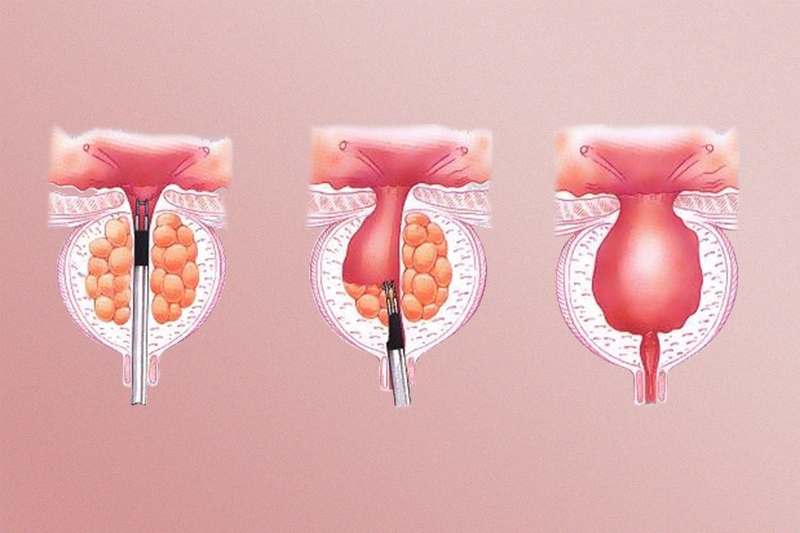Kích thước tuyến tiền liệt bao nhiêu là to? Thường thăm khám trên 40ml được tính là tuyến tiền liệt to