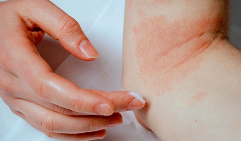 Kiến ba khoang cắn bôi povidine có được không? Cách phòng ngừa kiến ba khoang 1