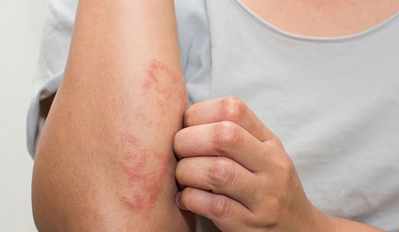 Kiến ba khoang cắn: Dấu hiệu nhận biết và cách xử trí nhanh chóng 2