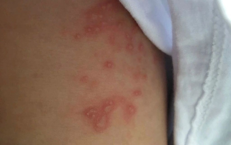 Kiến ba khoang cắn: Dấu hiệu nhận biết và cách xử trí nhanh chóng 1