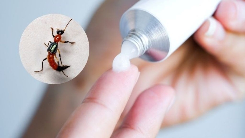 Kiến ba khoang cắn: Dấu hiệu nhận biết và cách xử trí nhanh chóng 3