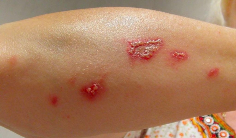 Kiến ba khoang đốt bôi kem đánh răng có được không? Cách chăm sóc vết thương 1