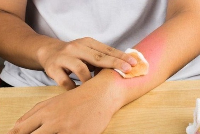 Kiến ba khoang đốt phải làm sao?