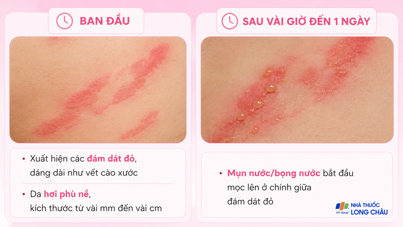 Chẩn đoán viêm da tiếp xúc do côn trùng chủ yếu dựa trên các biểu hiện lâm sàng đặc trưng