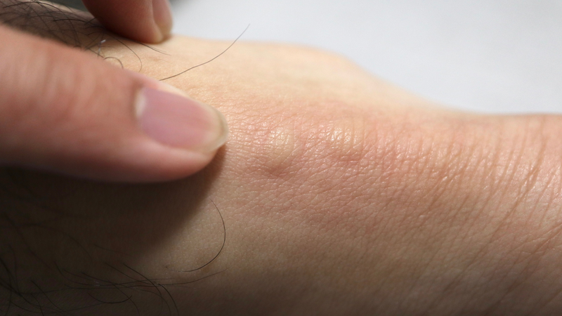 Không gãi hay chà xát mạnh tránh làm trầy xước khiến da dễ viêm nhiễm hơn