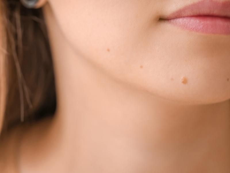 Kinh nghiệm chăm sóc da sau khi tẩy nốt ruồi 2