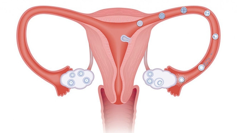 Kinh nguyệt kéo dài có đáng ngại không? Nguyên nhân và cách điều trị 3