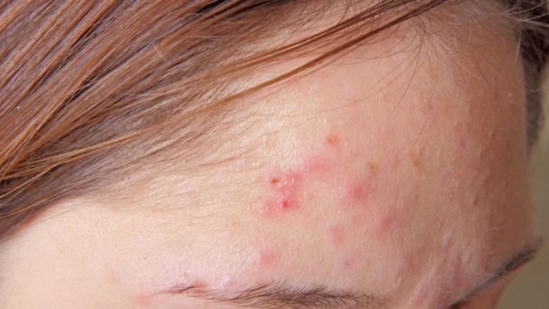 Ngứa và nổi mẩn đỏ trên da có thể là dấu hiệu cảnh báo nhiễm ký sinh trùng Demodex