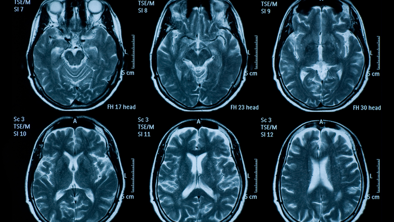 Kỹ thuật chụp ảnh não mới mang lại hy vọng phục hồi chức năng sau đột quỵ tốt hơn 3