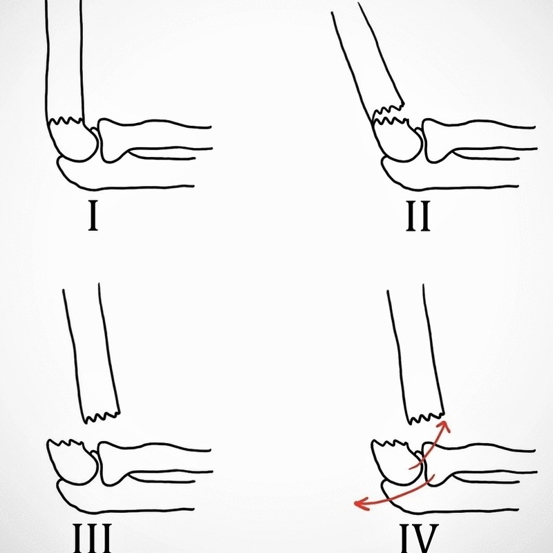 Kỹ thuật nắn trật khớp khuỷu chính xác nhất 3