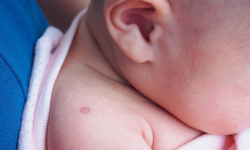 Kỹ thuật tiêm dưới da và những điều cần biết 3