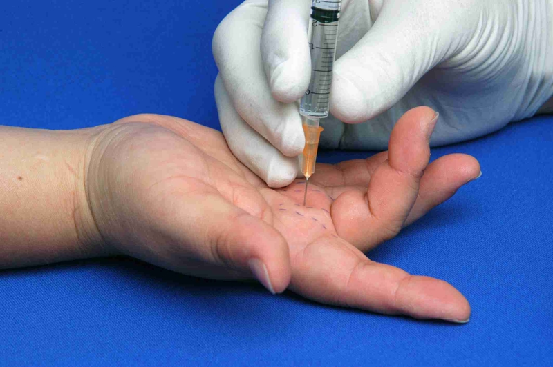 Kỹ thuật tiêm gân gấp ngón tay những thông tin cần biết  - 1