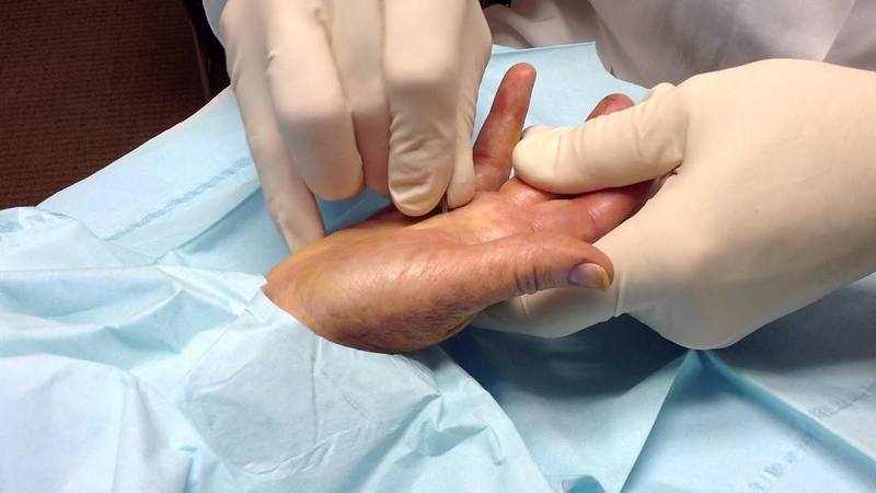 Kỹ thuật tiêm gân gấp ngón tay những thông tin cần biết  - 4