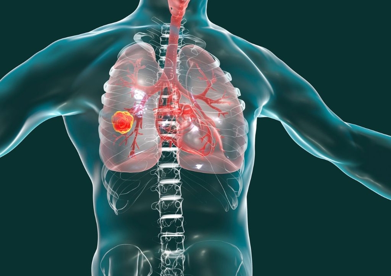 Kỹ thuật xạ trị ung thư phổi tại Singapore bệnh nhân ung thư nên biết