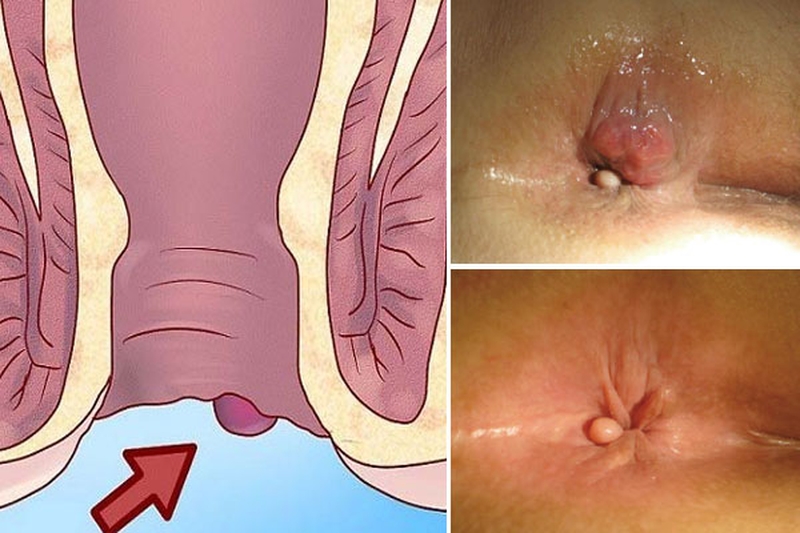 Cách chữa bệnh trĩ ngoại tại nhà hiệu quả nhất 1