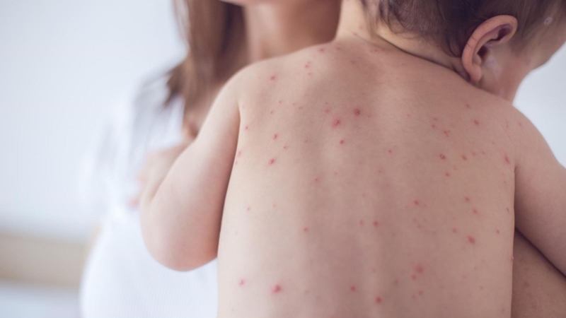 Tham khảo phương pháp dùng lá canh châu chữa thủy đậu 1