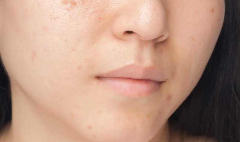 Làm cách nào để xóa sẹo thủy đậu 2