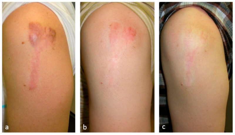 Làm gì để ngăn sẹo lồi phát triển 4