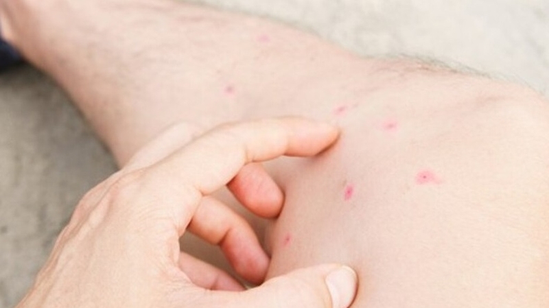 Làm gì khi bị bọ chét cắn? Cách xử lý hiệu quả nhất 3