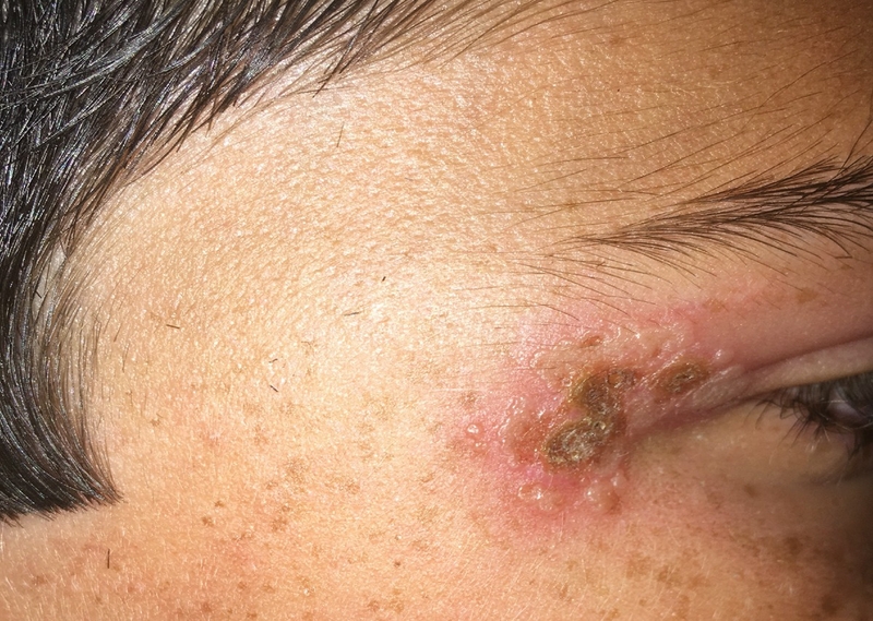 Làm gì khi bị zona ở mắt? Bệnh zona ở mắt có lây không? 2