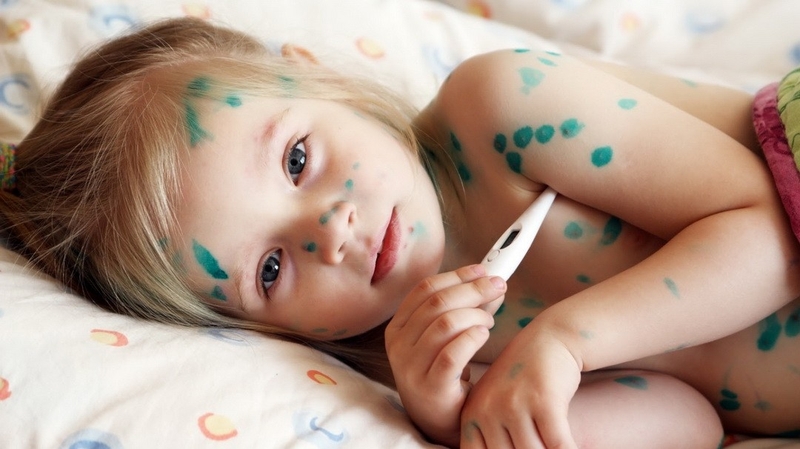 Tìm hiểu vấn đề mẹ cần làm gì khi trẻ bị thủy đậu 2