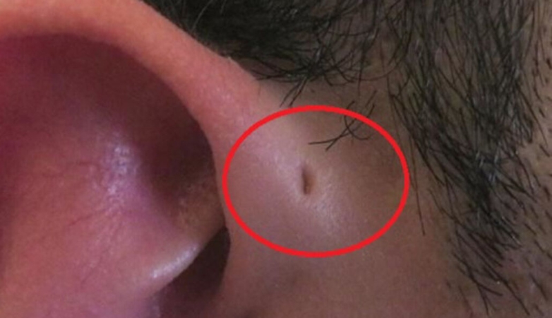 Làm phẫu thuật rò luân nhĩ hết bao nhiêu tiền? 1