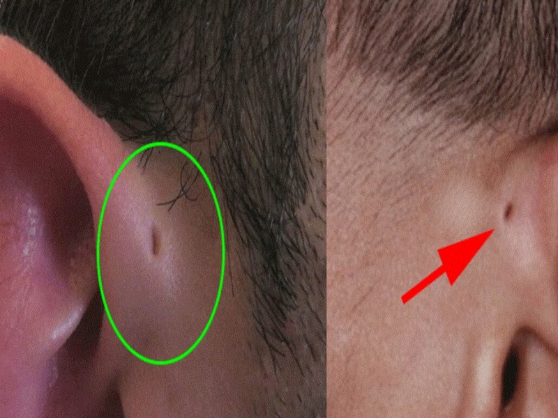 Làm phẫu thuật rò luân nhĩ hết bao nhiêu tiền? 2