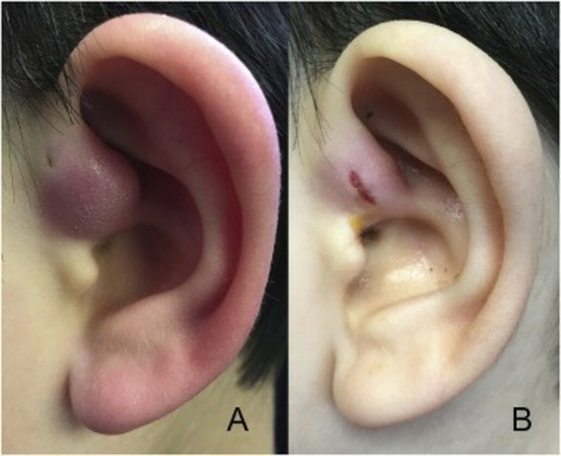 Làm phẫu thuật rò luân nhĩ hết bao nhiêu tiền? 3