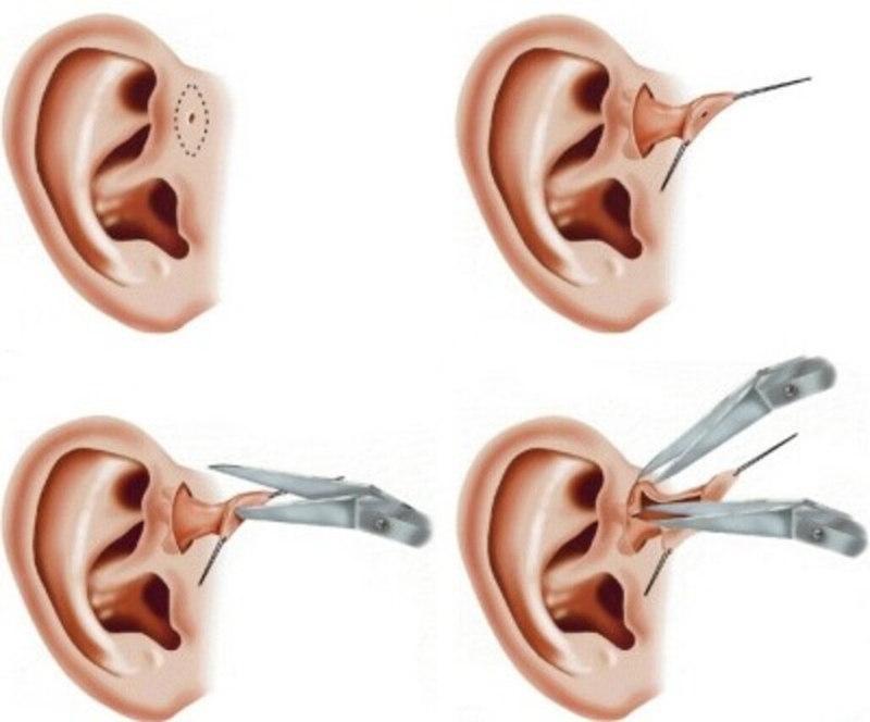 Làm phẫu thuật rò luân nhĩ hết bao nhiêu tiền? 4