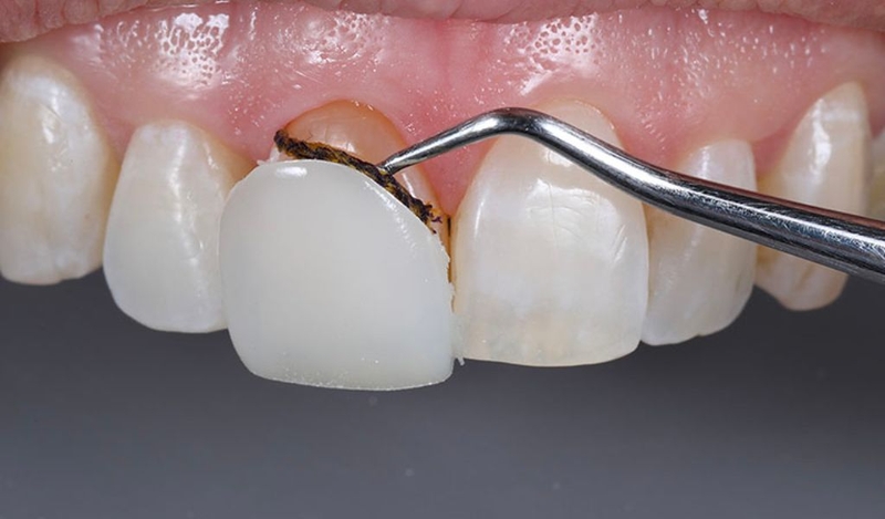 Làm răng sứ bị hở chân răng: Nguyên nhân do đâu và cách khắc phục 3