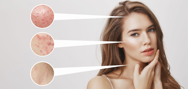 Phải làm sao biết mình bị mụn nội tiết? 2