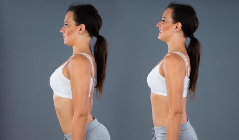 Làm sao để biết mình bị võng lưng? Lưu ý và cách điều trị 1