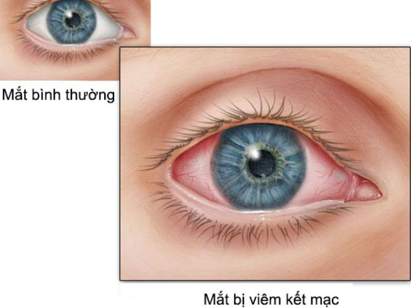 Làm sao để mắt hết nổi gân đỏ 1