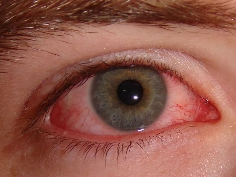 Làm sao để mắt hết nổi gân đỏ 2