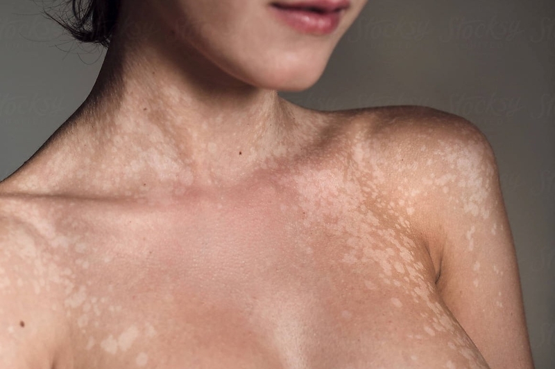 Làm sao để phân biệt lang ben và hắc lào? 2