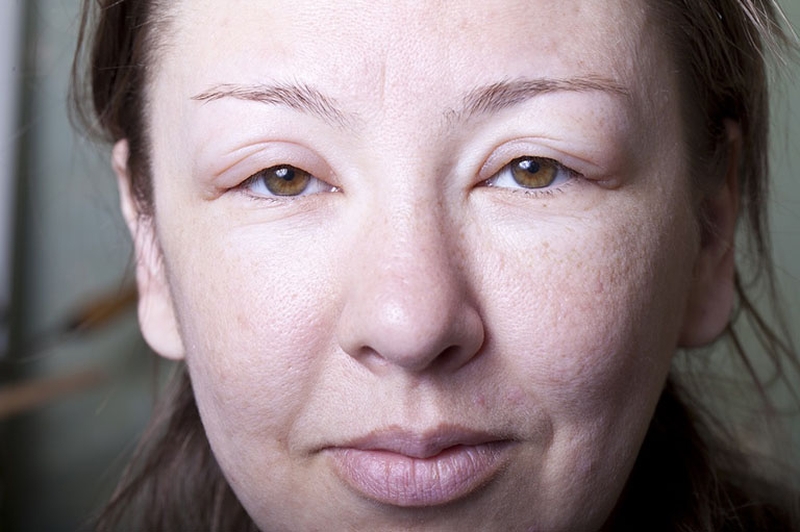 Phù quincke gây nhiều nguy cơ hơn so với mề đay mẩn ngứa thường gặp